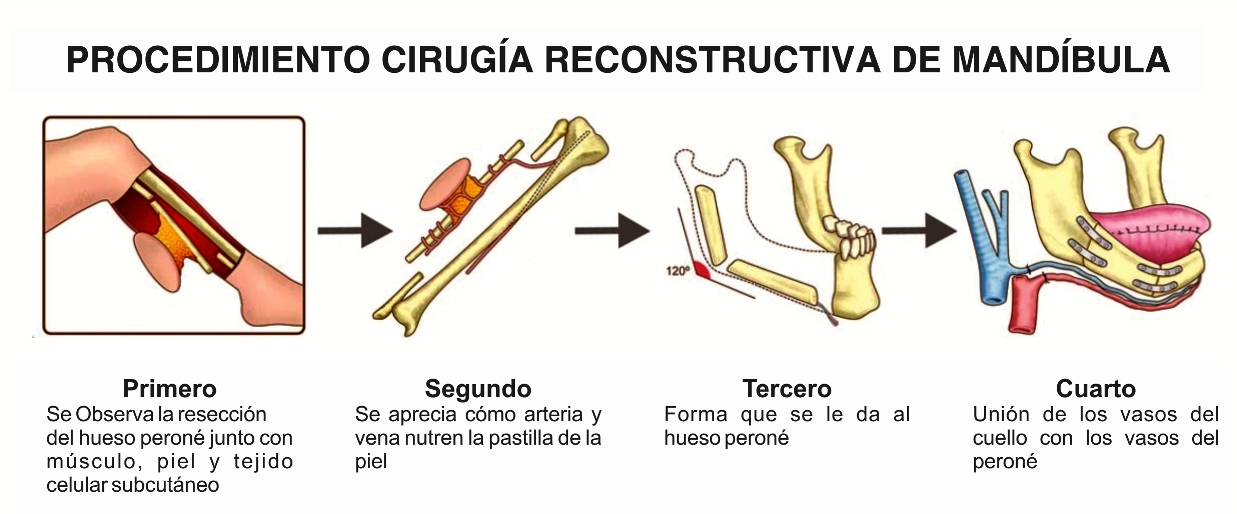 Reconstruccin-de-Mandbula