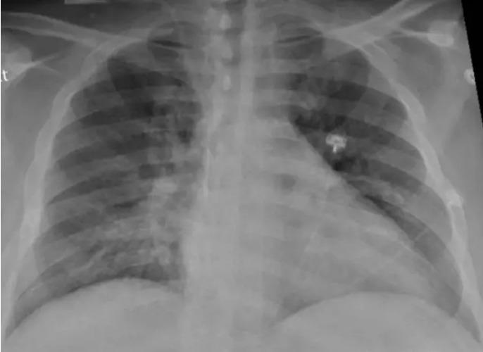 Pulmones COVID